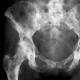 Как узнать, что есть метастазы в костях: симптомы